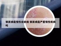 银屑病是慢性皮肤病 银屑病是严重慢性疾病吗
