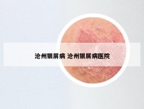 沧州银屑病 沧州银屑病医院