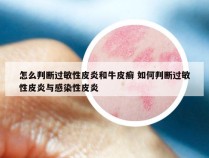 怎么判断过敏性皮炎和牛皮癣 如何判断过敏性皮炎与感染性皮炎