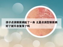 孩子点滴银屑病起了一身 儿童点滴型银屑病好了就不会复发了吗