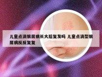 儿童点滴银屑病长大后复发吗 儿童点滴型银屑病反反复复