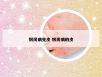 银屑病亮皮 银屑病的皮