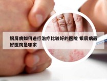 银屑病如何进行治疗比较好的医院 银屑病最好医院是哪家