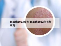 银屑病2023攻克 银屑病2022年有望攻克