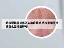 头皮型银屑病该怎么治疗最好 头皮型银屑病该怎么治疗最好呢