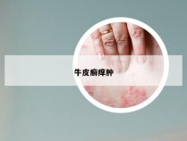 牛皮癣痒肿
