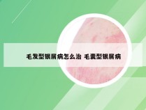 毛发型银屑病怎么治 毛囊型银屑病