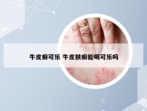 牛皮癣可乐 牛皮肤癣能喝可乐吗
