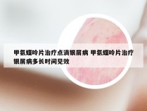 甲氨蝶呤片治疗点滴银屑病 甲氨蝶呤片治疗银屑病多长时间见效