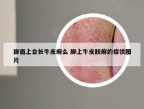 脚面上会长牛皮癣么 脚上牛皮肤癣的症状图片