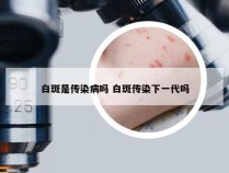 白斑是传染病吗 白斑传染下一代吗