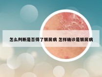 怎么判断是否得了银屑病 怎样确诊是银屑病