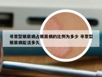 寻常型银屑病占银屑病的比例为多少 寻常型银屑病能活多久