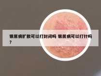 银屑病扩散可以打封闭吗 银屑病可以打针吗?