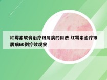 红霉素软膏治疗银屑病的用法 红霉素治疗银屑病60例疗效观察