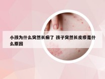 小孩为什么突然长癣了 孩子突然长皮疹是什么原因