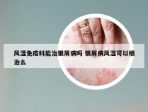 风湿免疫科能治银屑病吗 银屑病风湿可以根治么