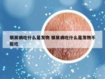 银屑病吃什么是发物 银屑病吃什么是发物不能吃