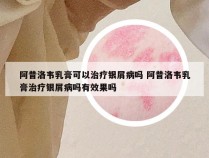 阿昔洛韦乳膏可以治疗银屑病吗 阿昔洛韦乳膏治疗银屑病吗有效果吗