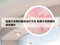 轻度牛皮癣的最佳治疗方法 轻度牛皮肤癣的症状图片