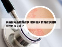 银癣图片最初期症状 银癣图片初期症状图片学校把孩子丢了