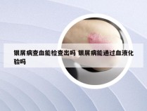 银屑病查血能检查出吗 银屑病能通过血液化验吗