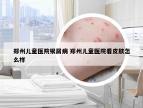 郑州儿童医院银屑病 郑州儿童医院看皮肤怎么样