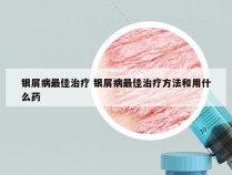 银屑病最佳治疗 银屑病最佳治疗方法和用什么药
