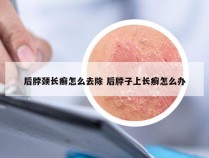 后脖颈长癣怎么去除 后脖子上长癣怎么办