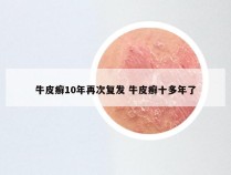 牛皮癣10年再次复发 牛皮癣十多年了