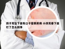 孩子耳坠下面有口子是银屑病 小孩耳垂下面烂了怎么回事