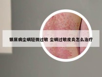 银屑病尘螨轻微过敏 尘螨过敏皮炎怎么治疗