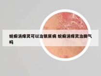 蜕癣消痒灵可以治银屑病 蜕癣消痒灵治脚气吗