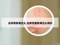 丘疹银屑病怎么 丘疹性银屑病怎么得的