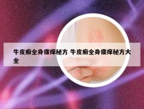 牛皮癣全身瘙痒秘方 牛皮癣全身瘙痒秘方大全