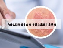 为什么胳膊长牛皮癣 手臂上出现牛皮肤癣