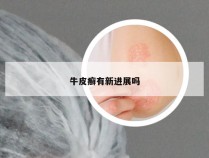 牛皮癣有新进展吗