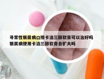 寻常性银屑病口擦卡泊三醇软膏可以治好吗 银屑病使用卡泊三醇软膏会扩大吗