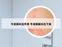 牛皮癣长在外阴 牛皮肤癣长在下体