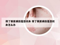 得了银屑病但是想纹身 得了银屑病但是想纹身怎么办