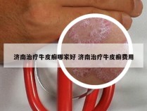 济南治疗牛皮癣哪家好 济南治疗牛皮癣费用