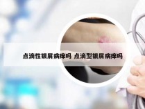 点滴性银屑病痒吗 点滴型银屑病痒吗