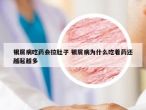 银屑病吃药会拉肚子 银屑病为什么吃着药还越起越多