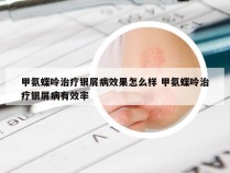 甲氨蝶呤治疗银屑病效果怎么样 甲氨蝶呤治疗银屑病有效率