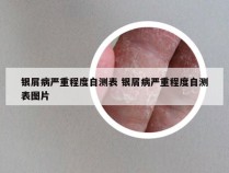 银屑病严重程度自测表 银屑病严重程度自测表图片