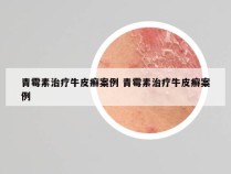 青霉素治疗牛皮癣案例 青霉素治疗牛皮癣案例