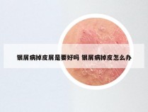 银屑病掉皮屑是要好吗 银屑病掉皮怎么办