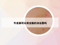 牛皮癣可以用含酸的沐浴露吗
