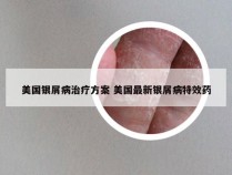 美国银屑病治疗方案 美国最新银屑病特效药