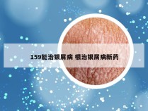 159能治银屑病 根治银屑病新药
